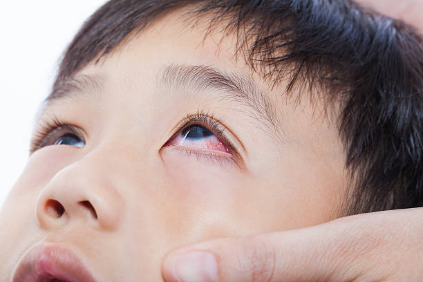 zbliżenie pinkeye (zapalenie spojówek) zakażenie - conjunctivitis sore eyes child human eye zdjęcia i obrazy z banku zdjęć