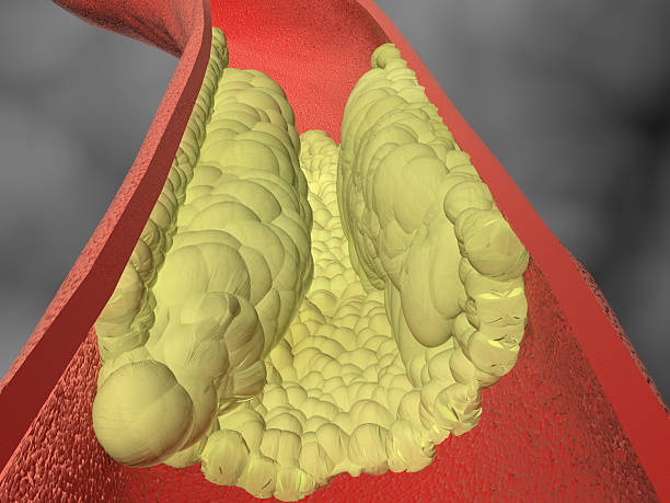 Clogged artery with cholesterol plaque stock photo