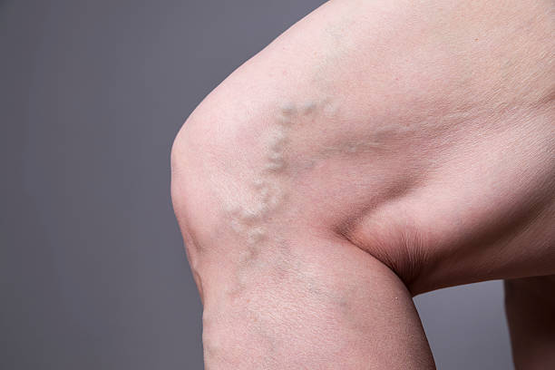 primer plano de las venas varicosas. patas femeninas gruesas - animal vein fotos fotografías e imágenes de stock