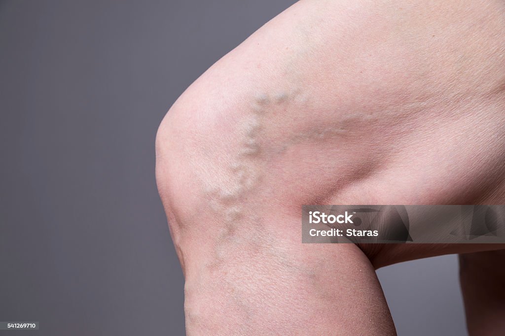 Varicose veins closeup. Thick female legs Varicose veins closeup. Thick female legs on a gray background Varicose Vein Stock Photo