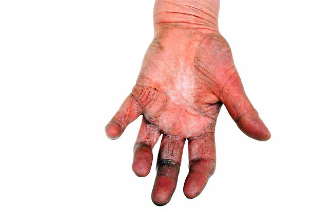 istock Arthritis of the hand 541287386