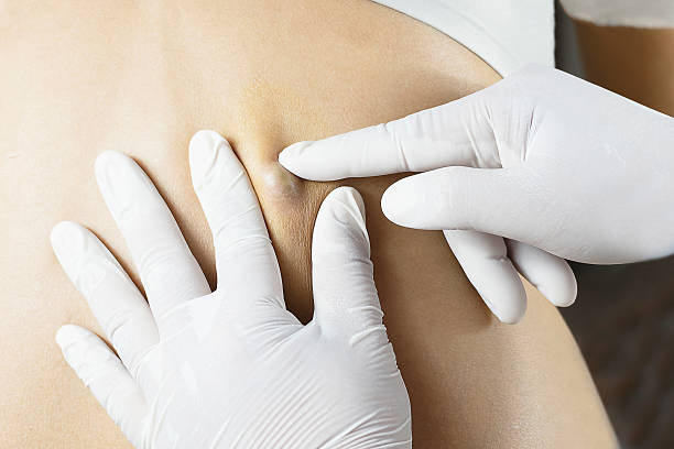 médecin diagnostic du sébacée sur le dos de la femme - kyste photos et images de collection