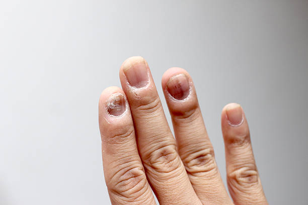 istock Finger with onychomycosis. - soft focus 541861656