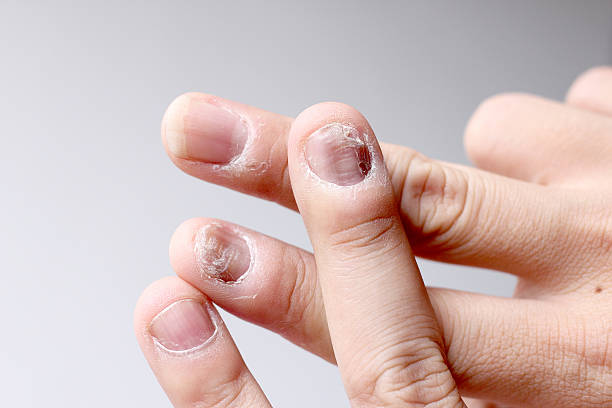 istock Finger with onychomycosis. - soft focus 541861716