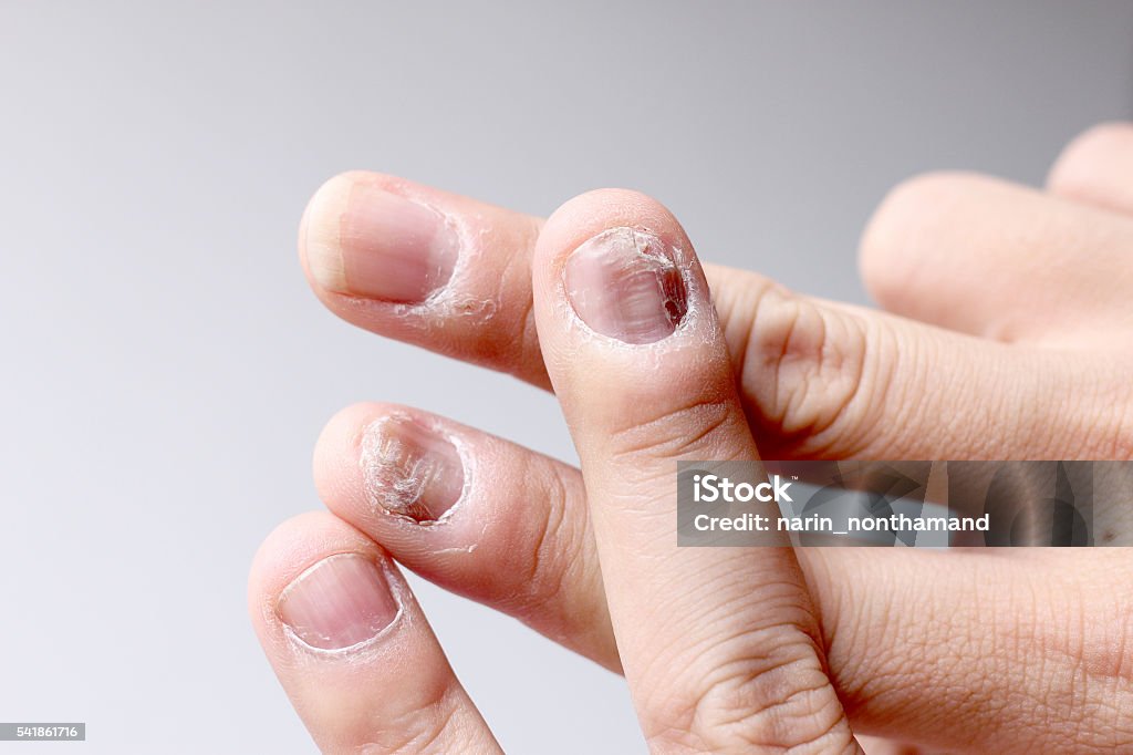 Finger with onychomycosis. - soft focus Fungus Infection on Nails Hand, Finger with onychomycosis. - soft focusFungus Infection on Nails Hand, Finger with onychomycosis. - soft focus Deformed Stock Photo