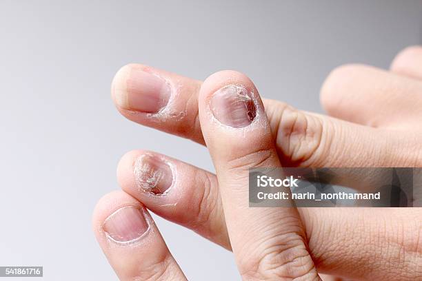 Finger With Onychomycosis Soft Focus Stock Photo - Download Image Now - Deformed, Dermatophyte, Fungal Disease