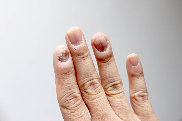 istock Finger with onychomycosis. - soft focus 541861824