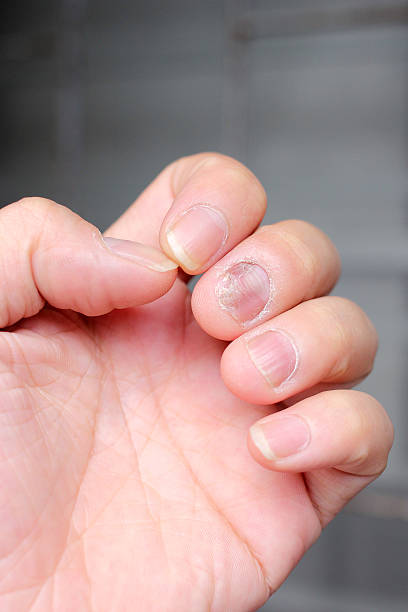 istock Finger with onychomycosis. - soft focus 541862066
