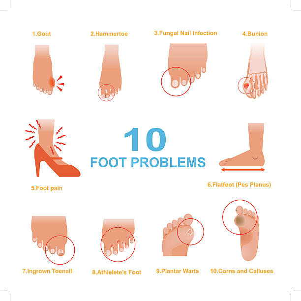 Foot Problems Vector of Common Foot Problems tinea stock illustrations