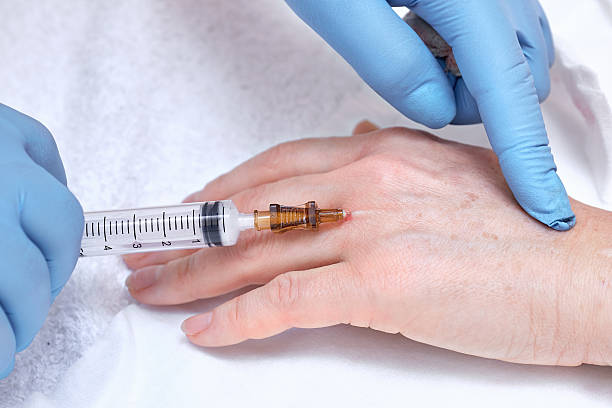 istock Anti-age injection therapy. Hand rejuvenation. 542206446