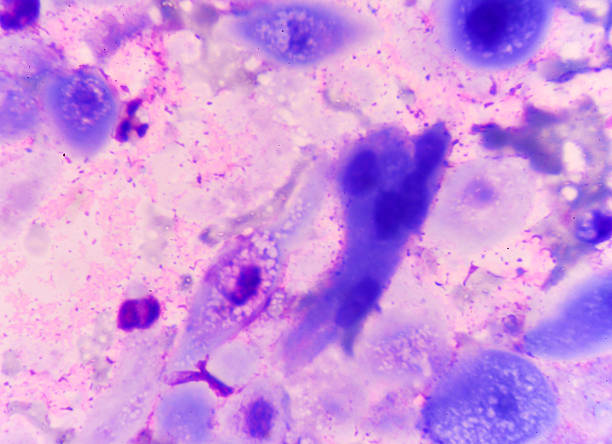 cell in human showing abnormal cells. - amyloid bildbanksfoton och bilder