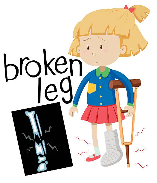 Vector illustration of Girl with broken leg and x-ray film