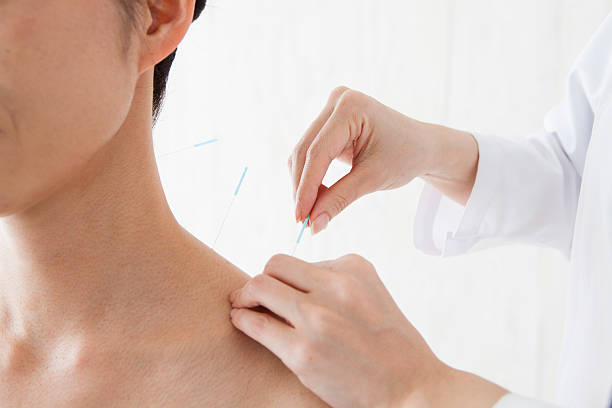 istock Patients receiving acupuncture treatment to shoulder 542566144