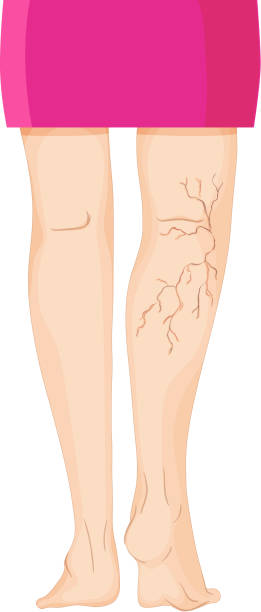 Varicose Veins On Human Legs Stock Illustration - Download Image Now - Varicose  Vein, Adult, Clip Art - iStock