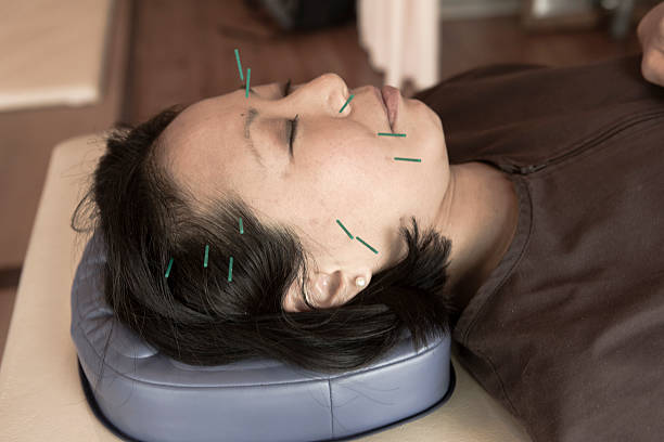 일본 여성 왔지 침술용 치료 일본 교토 - acupuncture needle 뉴스 사진 이미지
