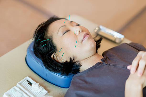 istock Adult woman getting acupuncture 542827900