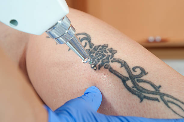 istock laser tattoo removal from leg 543058032