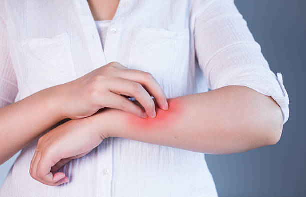 istock Woman Scratching Her Arm 543064770