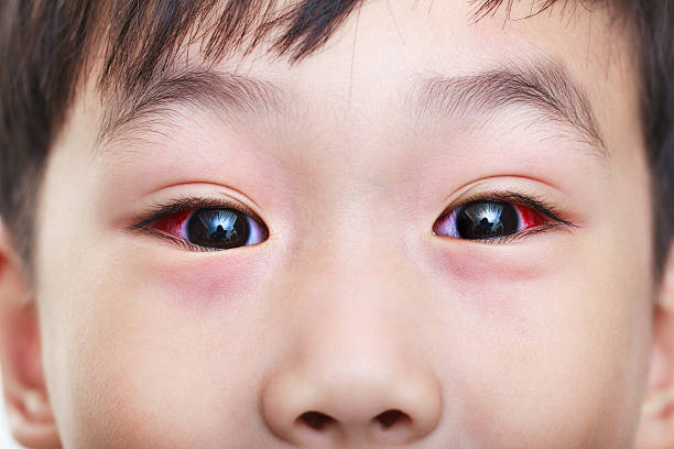 붉은 홍채와 만성 결막염의 클로즈업. - conjunctivitis sore eyes child human eye 뉴스 사진 이미지