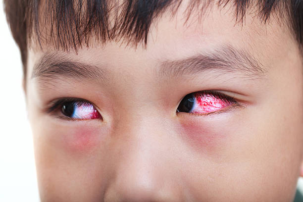 gros plan de la conjonctivite chronique avec l’iris rouge. - conjunctivitis sore eyes child human eye photos et images de collection