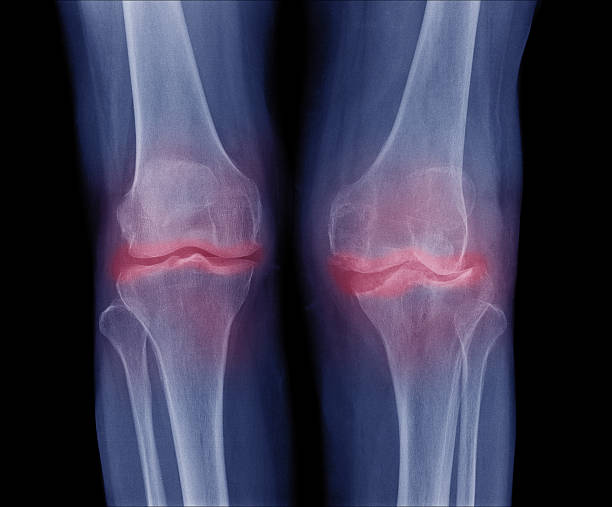 istock x-ray image of both knee Osteoarthritis (OA Knee) 543181560