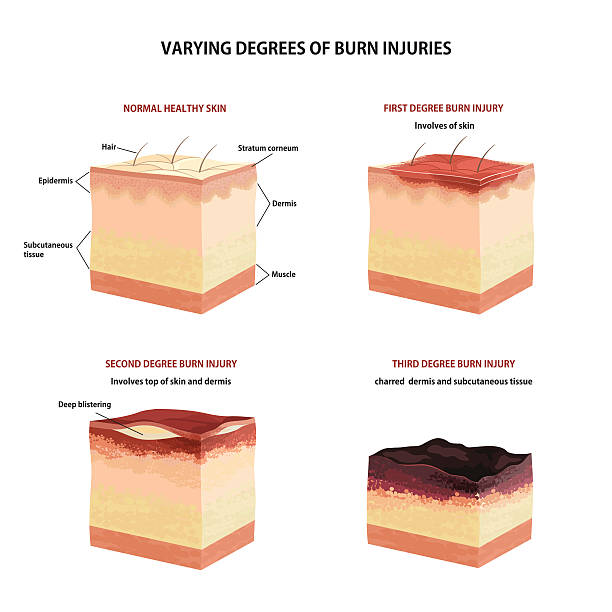 Sun Burn Classification 460+ Painful Sunburn Stock Illustrations, Royalty-Free Vector Graphics ...