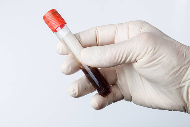 Blood probe hand with hygienic gloves holds a blood sample blood sugar test stock pictures, royalty-free photos & images