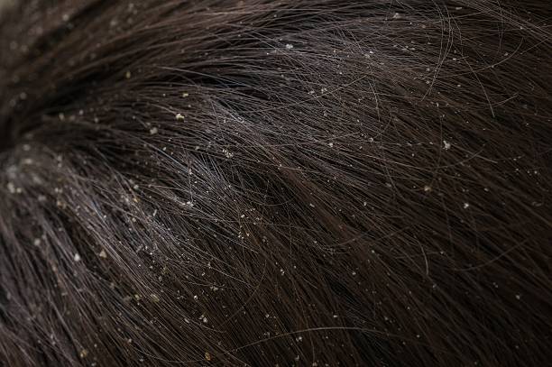istock White dandruff flakes in dry hair on head. 543359276
