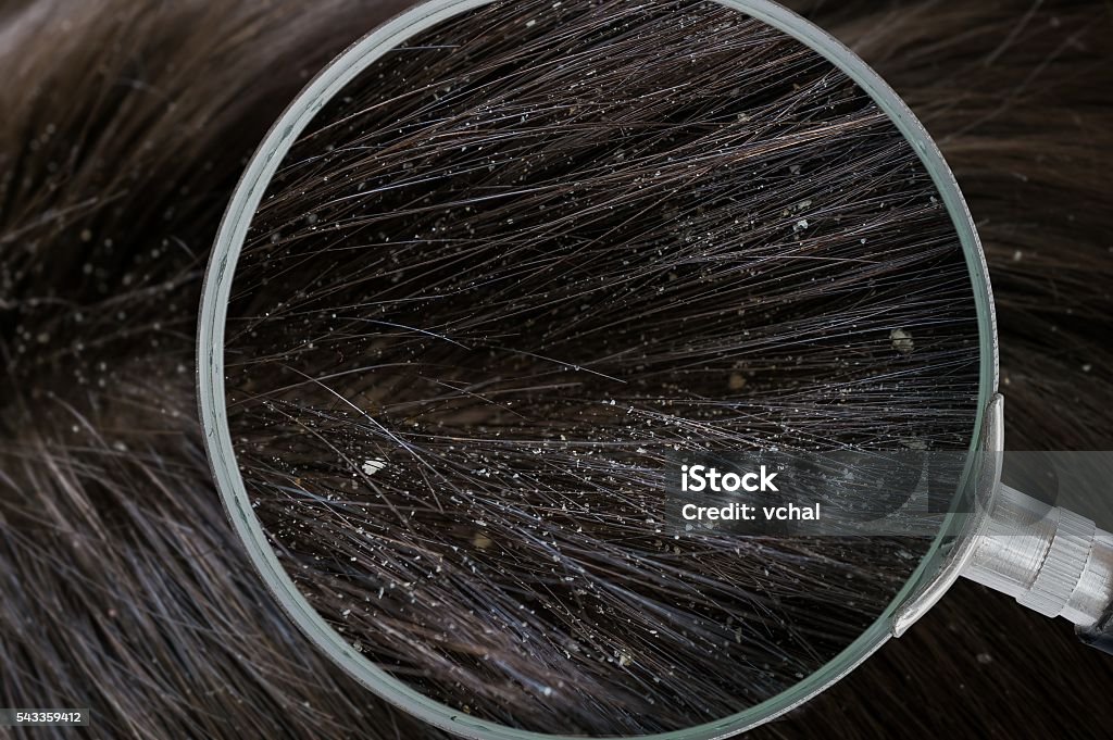Examiming white dandruff flakes in hair with magnifying glass. Adults Only Stock Photo