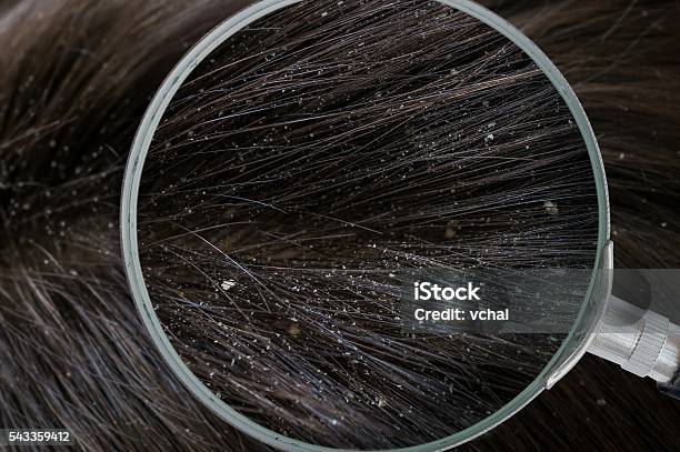 Examiming White Dandruff Flakes In Hair With Magnifying Glass Stock Photo - Download Image Now