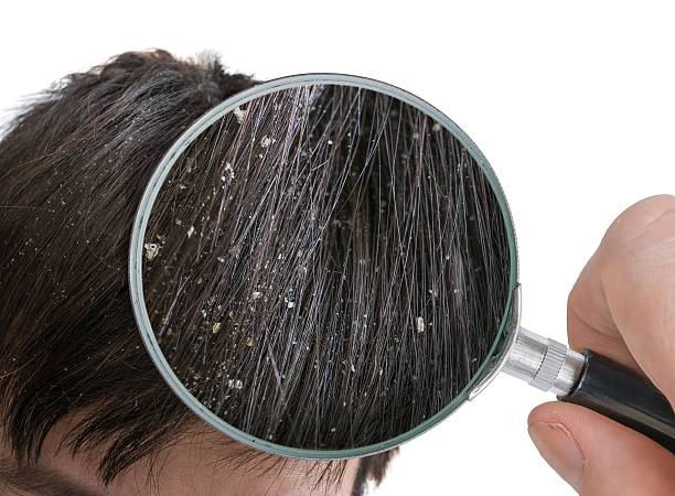 Examiming white dandruff flakes in hair with magnifying glass. stock photo