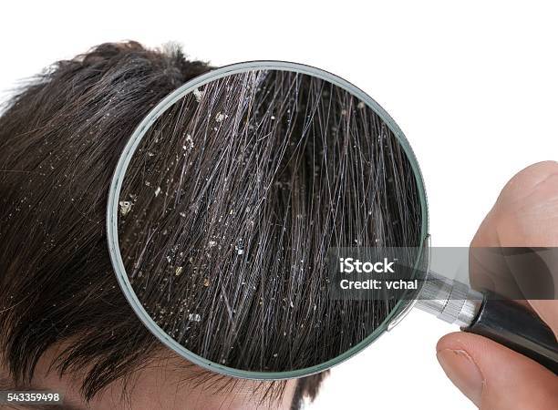 Examiming White Dandruff Flakes In Hair With Magnifying Glass Stock Photo - Download Image Now