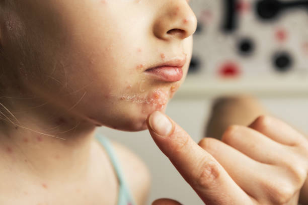 varicella/varicella - chickenpox skin condition baby illness foto e immagini stock