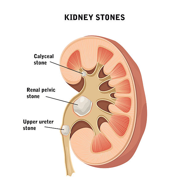 illustrazioni stock, clip art, cartoni animati e icone di tendenza di calcoli renali. - kidney stone