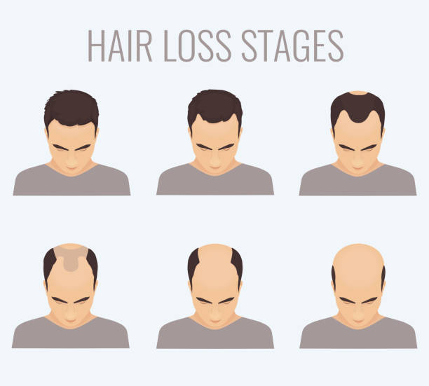 Male pattern baldness stages Male hair loss stages set. Top view portrait of a man losing hair. Male pattern baldness. Transplantation of hair. Signs of balding. Frontal hair loss. Vector illustration. completely bald stock illustrations