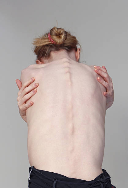 skinny bony back - anorexia imagens e fotografias de stock