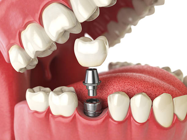 implant dentaire. concept dentaire. dents humaines ou prothèses dentaires. - artificial metal healthcare and medicine technology photos et images de collection