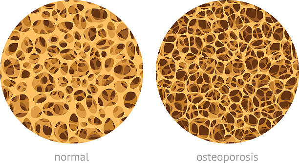 Bone spongy structure Bone spongy structure vector illustration, normal and with osteoporosis animal bone stock illustrations