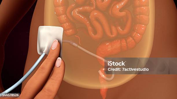 Peritoneal Dialysis Stock Photo - Download Image Now - Peritoneal Dialysis, Dialysis, Anatomy