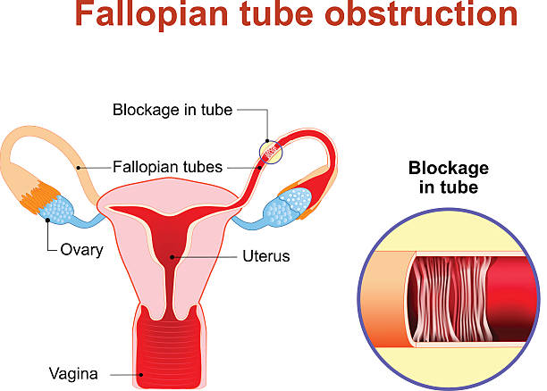 Fallopian tube obstruction Fallopian tube obstruction or Blocked fallopian tubes. A major cause of female infertility.  Uterus and uterine tubes. Human anatomy. female reproductive system. Vector diagram. fallopian tube stock illustrations