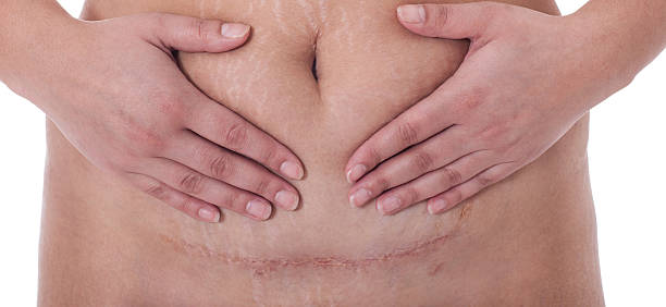 Scar after a Caesarean section, Bikini line scar from a c-section birth on a white background. scarification stock pictures, royalty-free photos & images