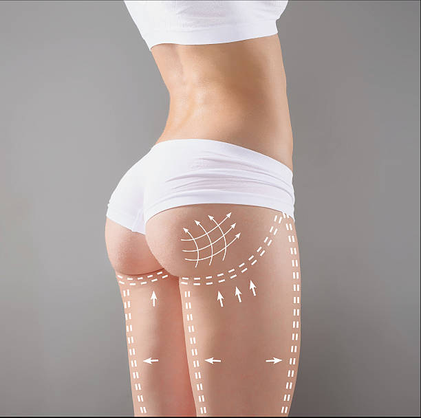 marks on the women's buttocks, waist and legs before - oppakken stockfoto's en -beelden