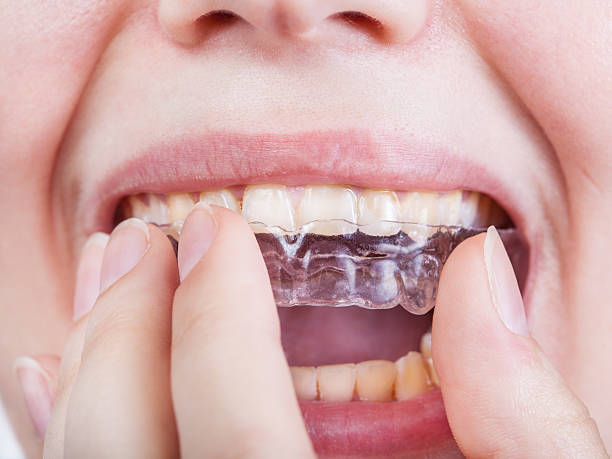 istock young woman puts clear aligner close up 545434236