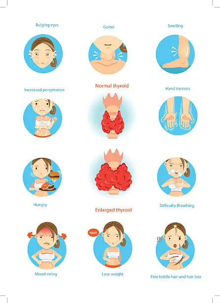 Vector illustration of Hyperthyroidism