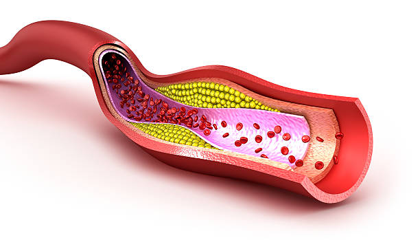 Cholesterol plaque in blood vessel Cholesterol plaque in blood vessel, illustration artery photos stock pictures, royalty-free photos & images