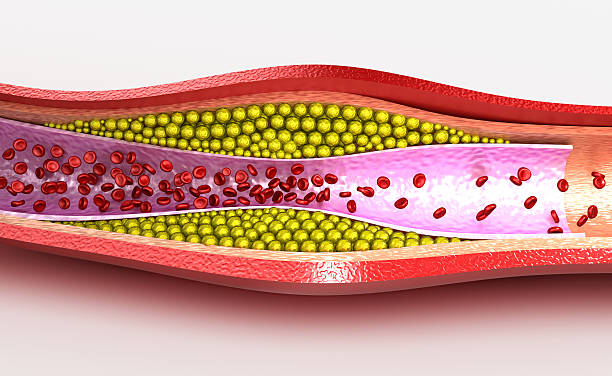 istock Cholesterol plaque in blood vessel 545574120