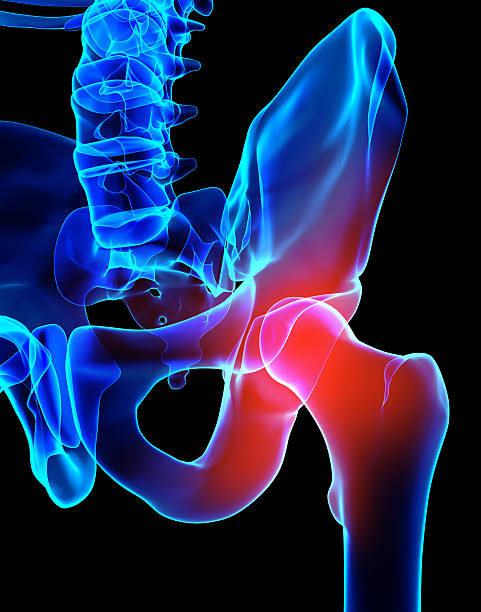 radiographie du squelette douloureux de la hanche, illustration 3d. - hip femur ilium pelvis photos et images de collection