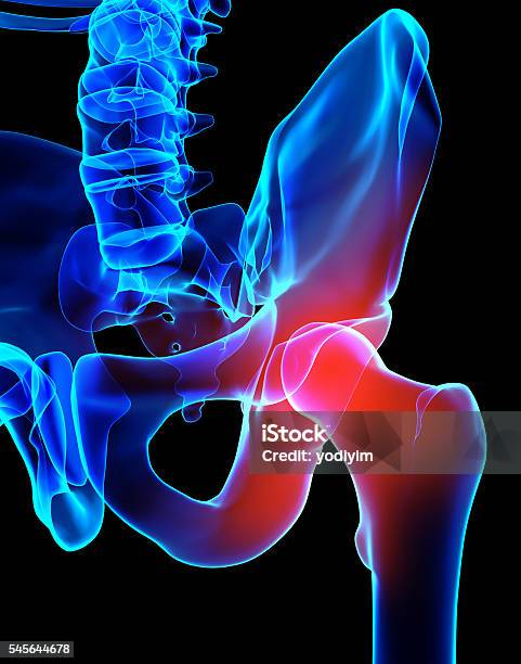 Hip Painful Skeleton Xray 3d Illustration Stock Photo - Download Image Now - Hip - Body Part, Joint - Body Part, Illustration