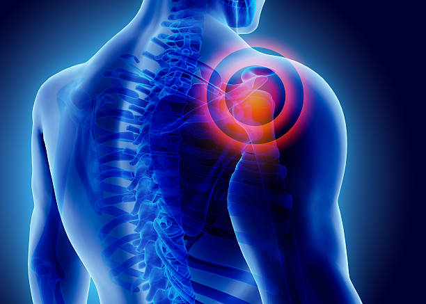 illustrazione 3d della spalla dolorosa. - dolore fisico illustrazioni foto e immagini stock