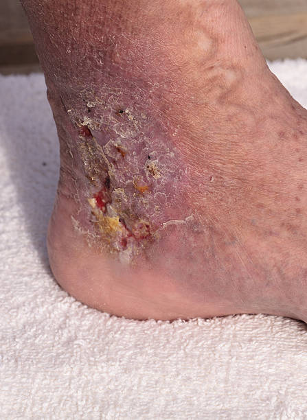 istock Medical picture: Infection cellulitis on the skin 546015696